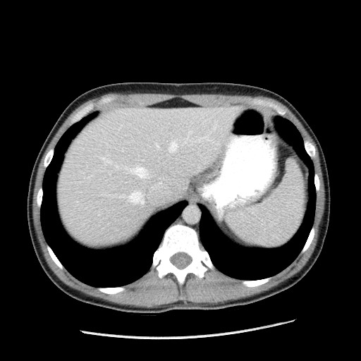 Castleman disease with fibrous pseudotumor in the abdomen (Radiopaedia 77296-89373 A 21).jpg