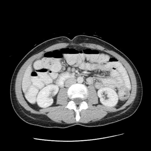 Castleman disease with fibrous pseudotumor in the abdomen (Radiopaedia 77296-89373 A 61).jpg