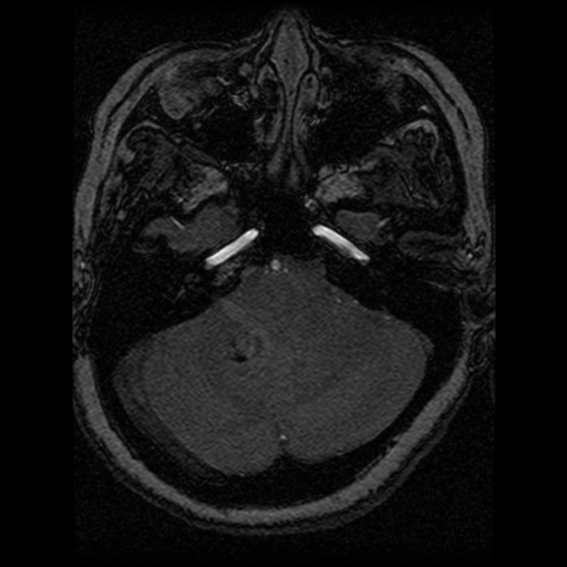 Cavernoma, DVA and right ICA aneurysm (Radiopaedia 33890-35072 E 83).png