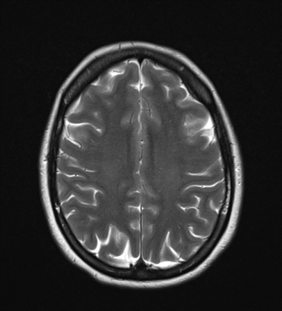 File:Cavernoma with bleed - midbrain (Radiopaedia 54546-60774 Axial T2 20).png