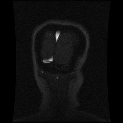 File:Cavernoma with developmental venous anomaly (Radiopaedia 22470-22507 MRV 28).jpg