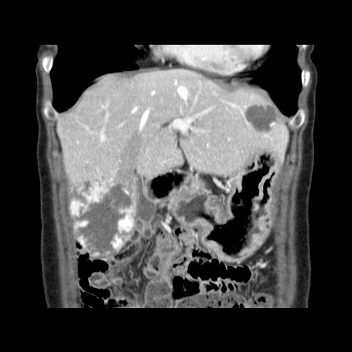 Cavernous hepatic hemangioma (Radiopaedia 75441-86667 C 42).jpg