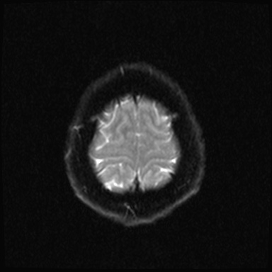 Cavernous sinus meningioma (Radiopaedia 63682-72367 DWI 20).jpg