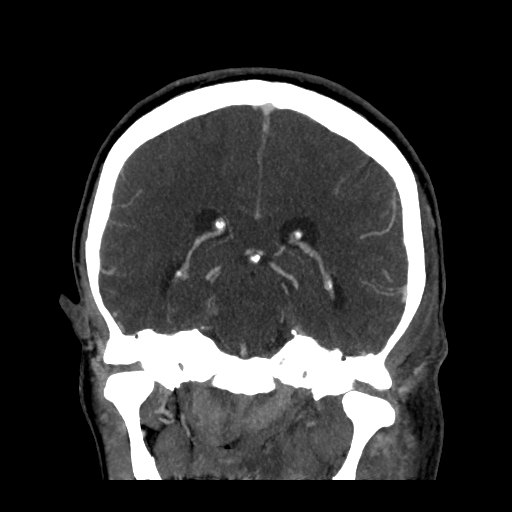 File:Cavernous sinus thrombosis (Radiopaedia 10619-11078 D 18).jpg