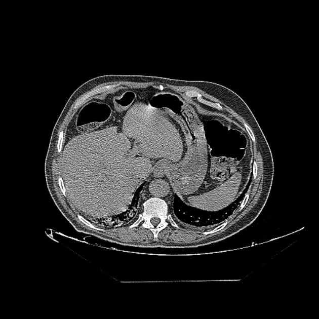 Cavitating bronchogenic carcinoma (Radiopaedia 44489-48162 Axial non-contrast 78).jpg
