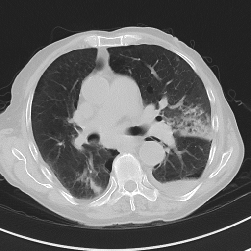 Cavitating pneumonia - lingular segments (Radiopaedia 34386-35678 Axial lung window 29).png