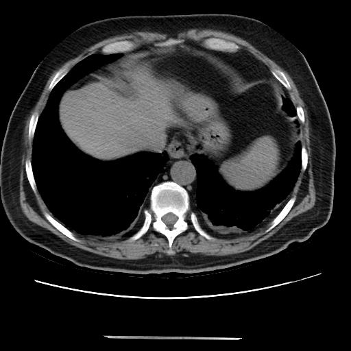 Cavitating pulmonary metastases (Radiopaedia 89545-106544 Axial non-contrast 45).jpg