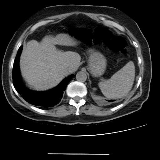 Cavitating pulmonary metastases (Radiopaedia 89545-106544 Axial non-contrast 50).jpg