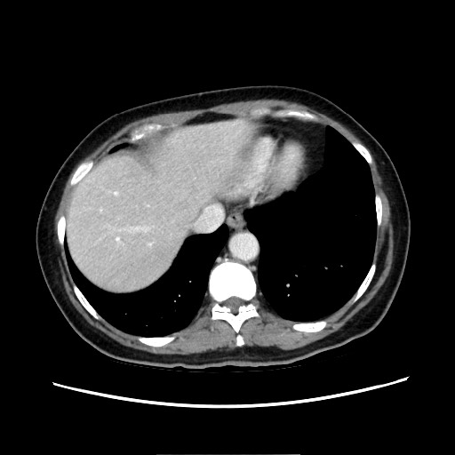 Cecal adenocarcinoma (Radiopaedia 75909-87331 A 17).jpg