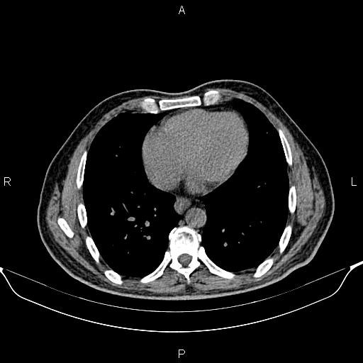 Cecal adenocarcinoma (Radiopaedia 85324-100916 Axial non-contrast 2).jpg