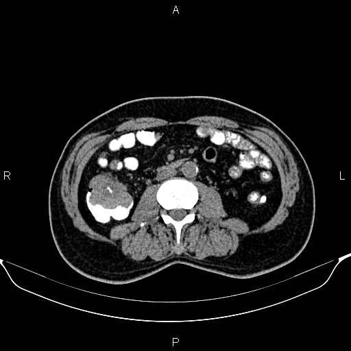 Cecal adenocarcinoma (Radiopaedia 85324-100916 Axial non-contrast 49).jpg