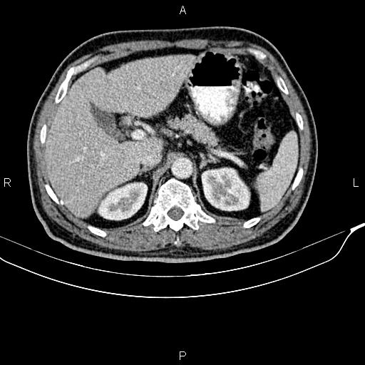 Cecal cancer with appendiceal mucocele (Radiopaedia 91080-108651 B 31).jpg