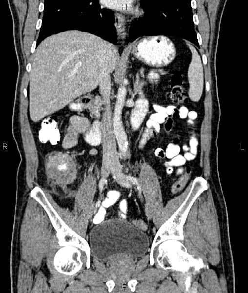 Cecal cancer with appendiceal mucocele (Radiopaedia 91080-108651 D 39).jpg