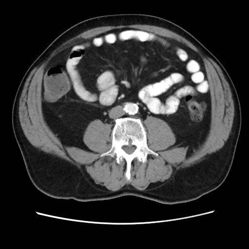 Cecal mass causing appendicitis (Radiopaedia 59207-66531 A 50).jpg