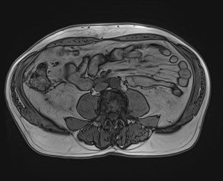 Cecal mass causing appendicitis (Radiopaedia 59207-66532 D 79).jpg