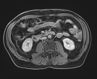 Cecal mass causing appendicitis (Radiopaedia 59207-66532 J 70).jpg
