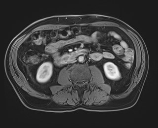 Cecal mass causing appendicitis (Radiopaedia 59207-66532 T1 C+ PV phase 72).jpg