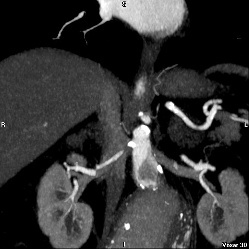 File:Celiac artery anatomy (Radiopaedia 16763-16476 A 13).jpg