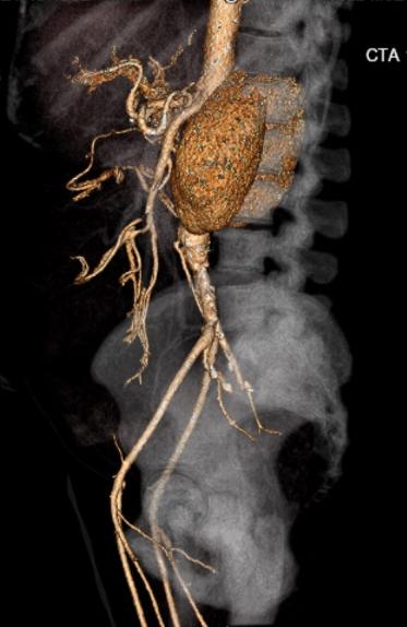 File:Celiac artery severe stenosis and dissection (Radiopaedia 44128-47842 C+ arterial phase 21).jpg