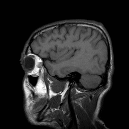File:Central-variant posterior reversible encephalopathy syndrome (PRES) (Radiopaedia 43880-47358 Sagittal T1 19).jpg