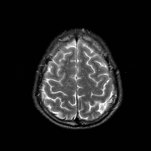 File:Central-variant posterior reversible encephalopathy syndrome (PRES) (Radiopaedia 43880-47359 Axial T2 20).jpg