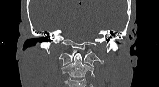 File:Central giant cell granuloma (Radiopaedia 83346-97761 Coronal bone window 33).jpg