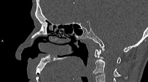 File:Central giant cell granuloma (Radiopaedia 83346-97761 Sagittal bone window 22).jpg
