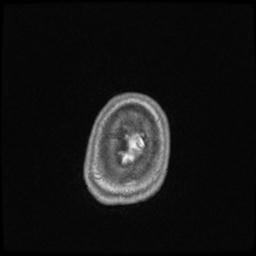 Central neurocytoma (Radiopaedia 30220-30842 Axial T1 C+ 146).jpg