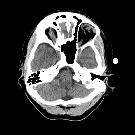 Central neurocytoma (Radiopaedia 68725-78432 Axial non-contrast 10).jpg