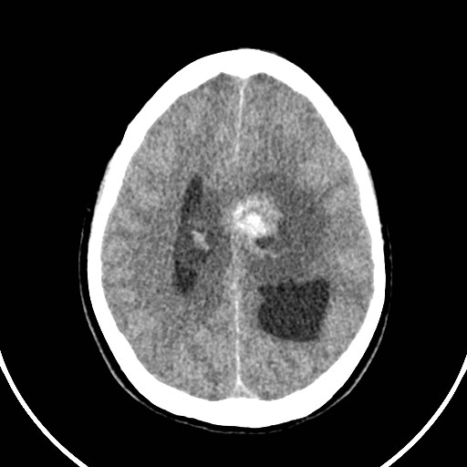 Central neurocytoma (Radiopaedia 84497-99871 Axial non-contrast 35).jpg