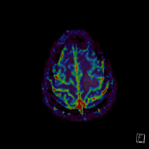 Central neurocytoma (Radiopaedia 84497-99872 Axial Perfusion 36).jpg
