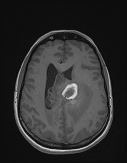 Central neurocytoma (Radiopaedia 84497-99872 Axial T1 129).jpg