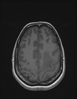 Central neurocytoma (Radiopaedia 84497-99872 Axial T1 150).jpg
