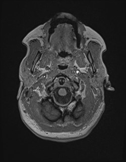 File:Central neurocytoma (Radiopaedia 84497-99872 Axial T1 26).jpg