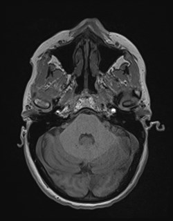File:Central neurocytoma (Radiopaedia 84497-99872 Axial T1 53).jpg