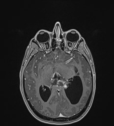 Central neurocytoma (Radiopaedia 84497-99872 Axial T1 C+ 72).jpg
