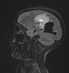 Central neurocytoma (Radiopaedia 84497-99872 Sagittal Flair + Gd 101).jpg