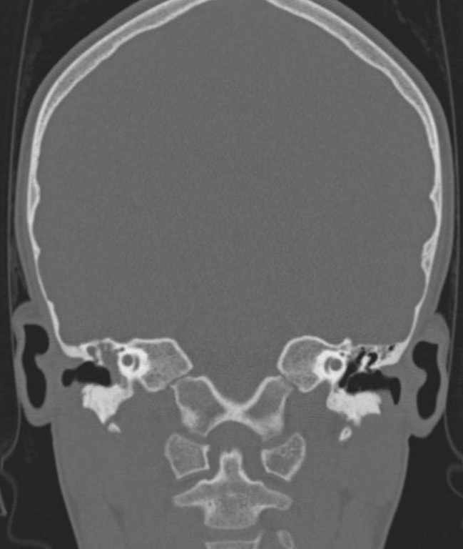 Cerebellar abscess (Radiopaedia 73727-84527 Coronal bone window 67).jpg