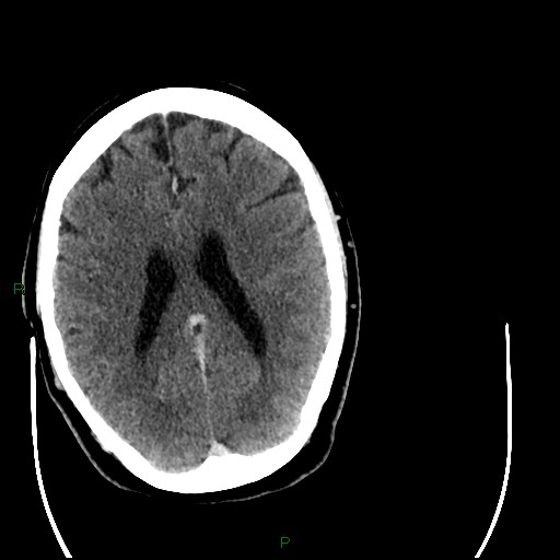 Cerebellar abscess (Radiopaedia 78135-90671 Axial C+ delayed 67).jpg