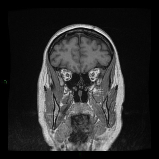 Cerebellar abscess (Radiopaedia 78135-90678 Coronal T1 C+ 38).jpg