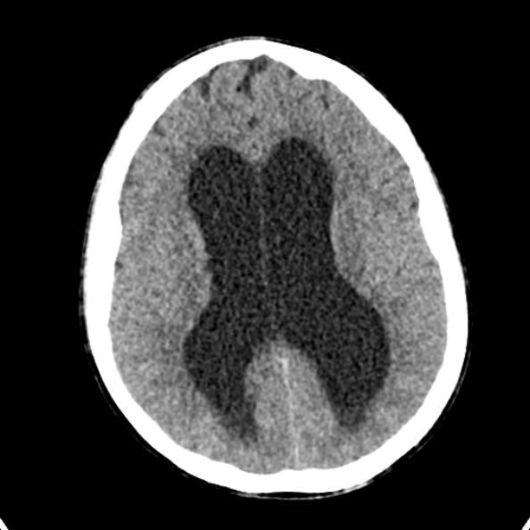 Cerebellar abscess secondary to mastoiditis (Radiopaedia 26284-26412 Axial non-contrast 94).jpg