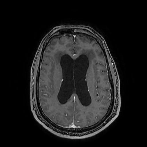 Cerebellar hemangioblastoma (Radiopaedia 88055-104622 Axial T1 C+ 111).jpg