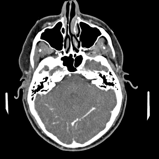 Cerebellar infarct due to vertebral artery dissection with posterior fossa decompression (Radiopaedia 82779-97029 C 11).png