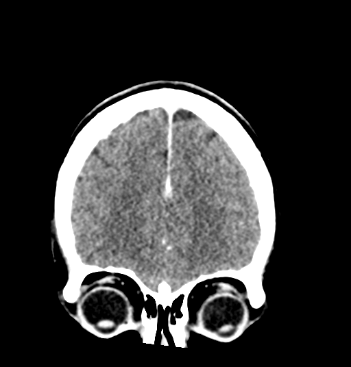 Cerebellar metastases - colorectal adenocarcinoma (Radiopaedia 40947-43652 Coronal C+ 22).png
