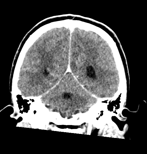 Cerebellar metastases - colorectal adenocarcinoma (Radiopaedia 40947-43652 Coronal C+ 63).png