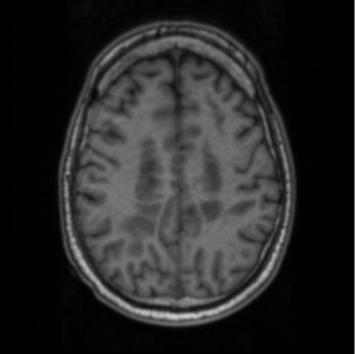 Cerebellar metastasis from lung adenocarcinoma (Radiopaedia 86690-102829 Axial T1 59).png