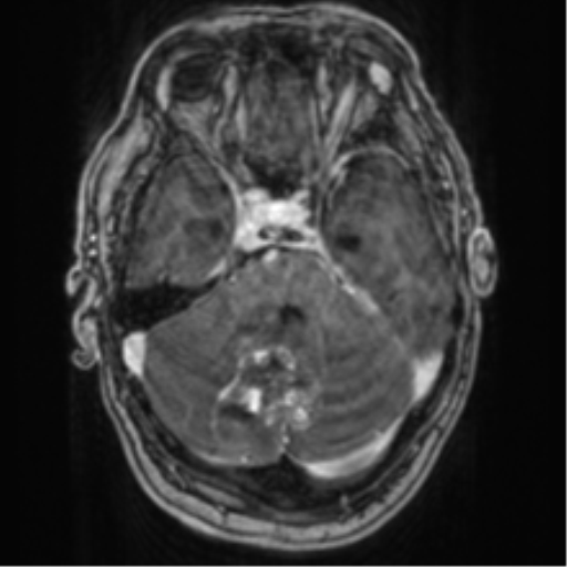 Cerebellar metastasis from lung adenocarcinoma (Radiopaedia 86690-102829 Axial T1 C+ 26).png