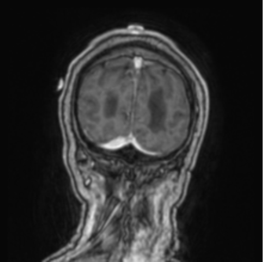 Cerebellar metastasis from lung adenocarcinoma (Radiopaedia 86690-102829 Coronal T1 C+ 12).png