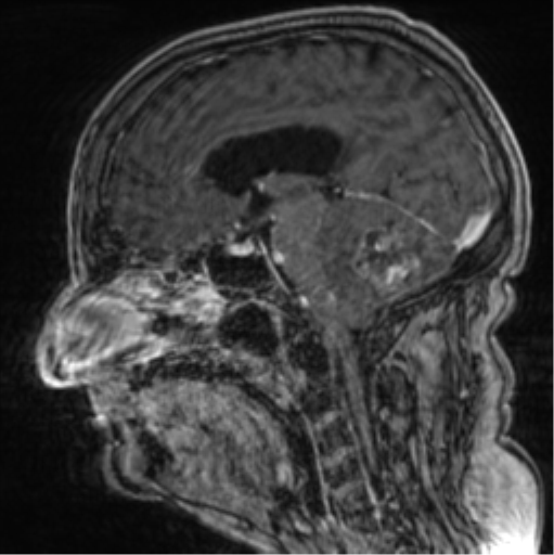 Cerebellar metastasis from lung adenocarcinoma (Radiopaedia 86690-102829 Sagittal T1 C+ 44).png