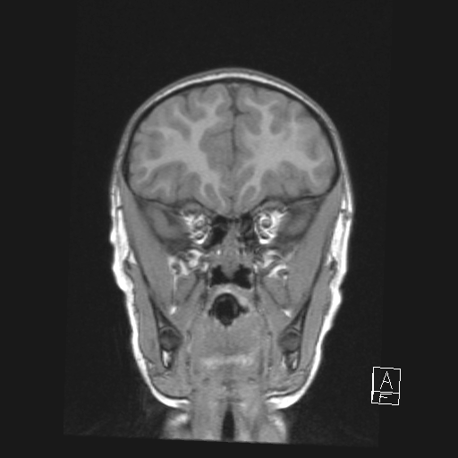 Cerebellar stroke (Radiopaedia 32202-33150 Coronal T1 15).png